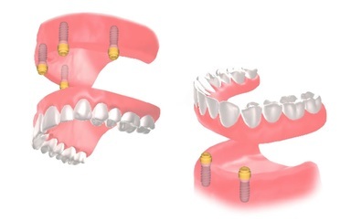 overdenture02img010